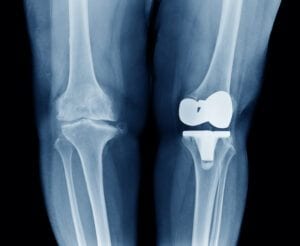 What is Degenerative Osteoarthritis- My Aching Bones  - Osteoarthritis-Knee Comparison - Left Arthroplasty -Total Knee Replacement and Untouched Right Knee
