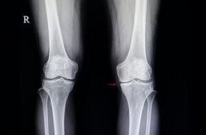 What is Degenerative Osteoarthritis- My Aching Bones  - Xray of Degenerative Osteoarthritis