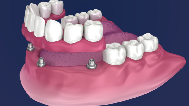 Dental Implants vs Dentures - OverDentures