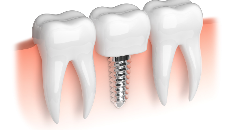 Dental Implants vs Dentures - Implant