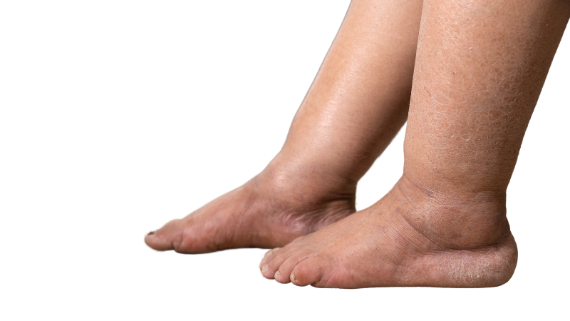 Causes of Leg Swelling in the Elderly - swollen legs