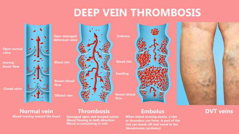 Causes of Leg Swelling in the Elderly - deep vein thrombosis (DVT)