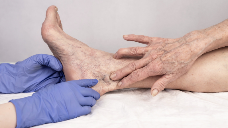 Causes of Leg Swelling in the Elderly - Doctor examining lower leg of elderly woman