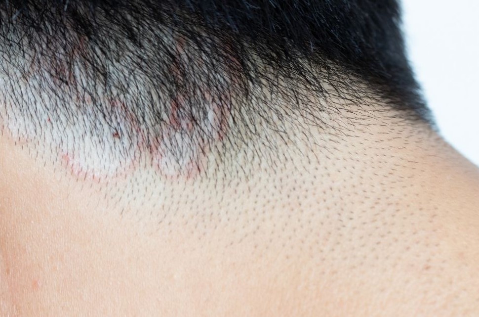 Medical Reasons for Hair Loss - Ringworm