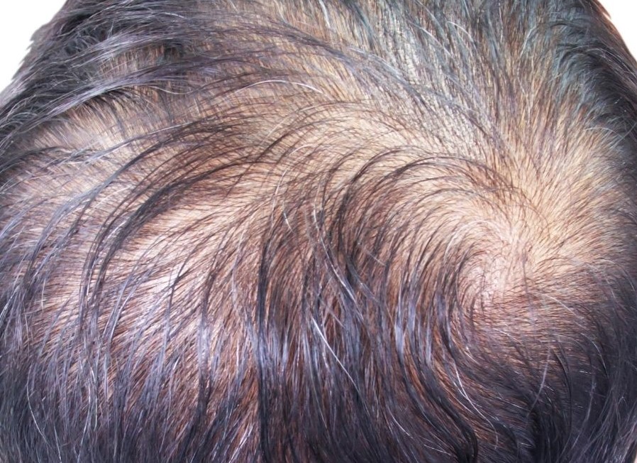Medical Reasons for Hair Loss - Telogen Effluvium