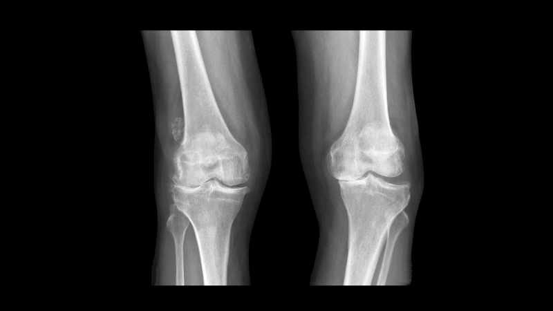 What is Degenerative Osteoarthritis? Xray of knees